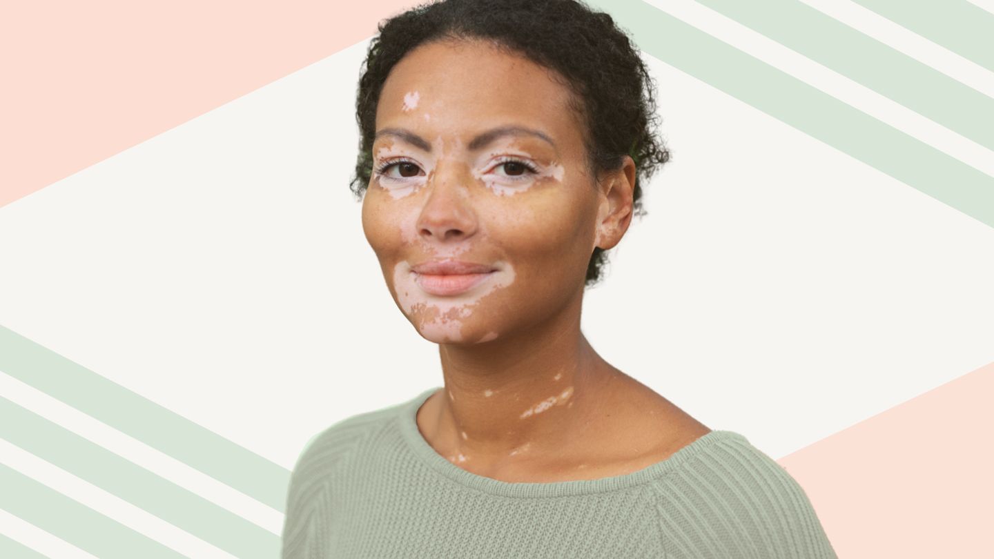 Ruxolitinib for Vitiligo: What We Know So Far – Unite For Vitiligo