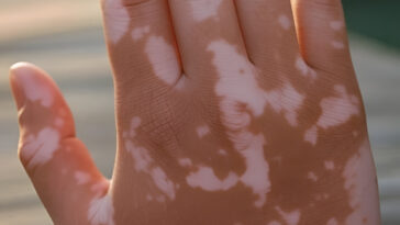 hand with vitiligo